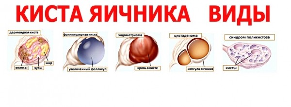 Киста яичника — опасные и безопасные варианты опухоли и методы их лечения