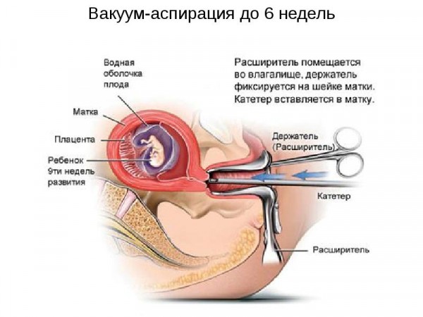 Насколько опасен мини аборт и его последствия