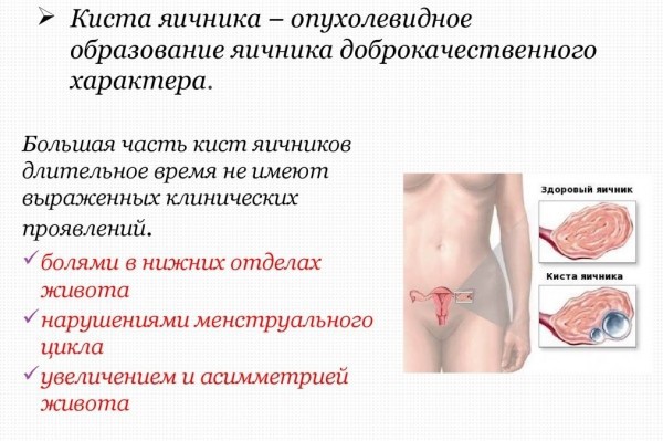 Киста яичника — опасные и безопасные варианты опухоли и методы их лечения