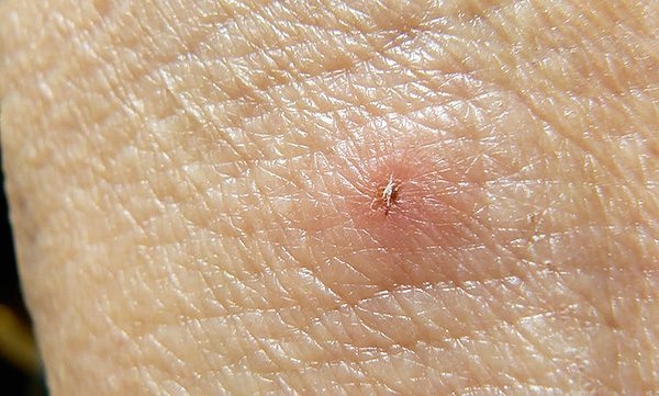 Хождение по мукам с укусом клеща: феерический личный опыт
