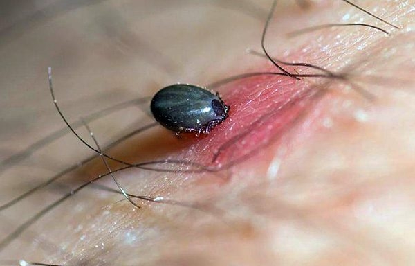 Хождение по мукам с укусом клеща: феерический личный опыт