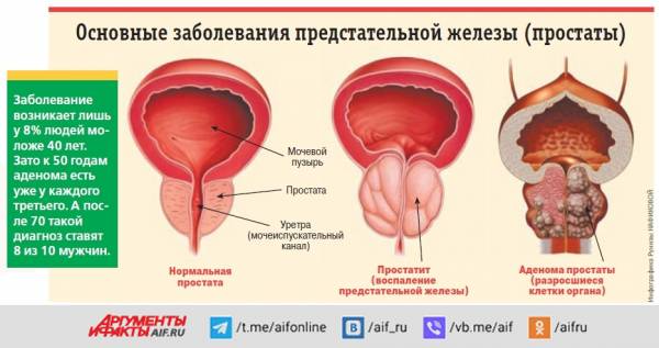 
        Разрослось, где не надо. Как отличить аденому простаты от других болезней    
