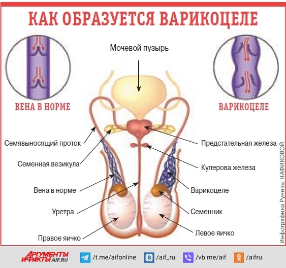 
        Нет наследника. Что такое варикоцеле и как его лечить    