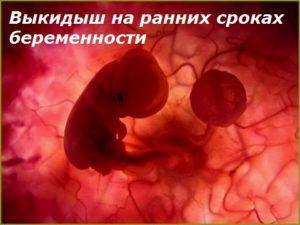 Почему на ранних сроках бывают выкидыши
